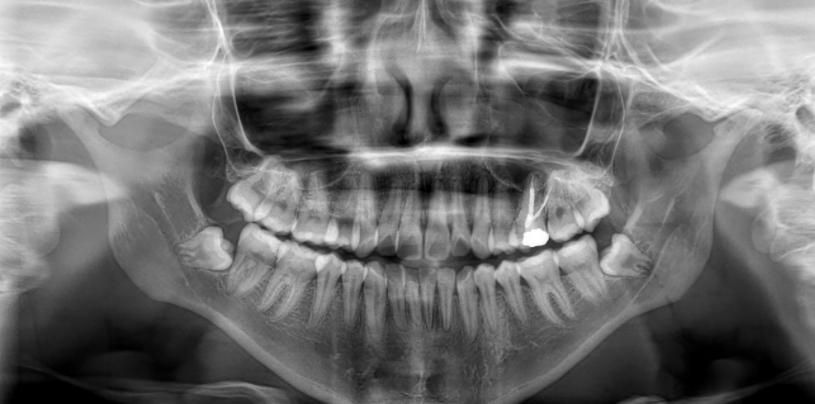 Radiografía panorámica para planificación de cirugía de 3eros molares en BGA Palermo — diagnóstico radiológico previo a la extracción
