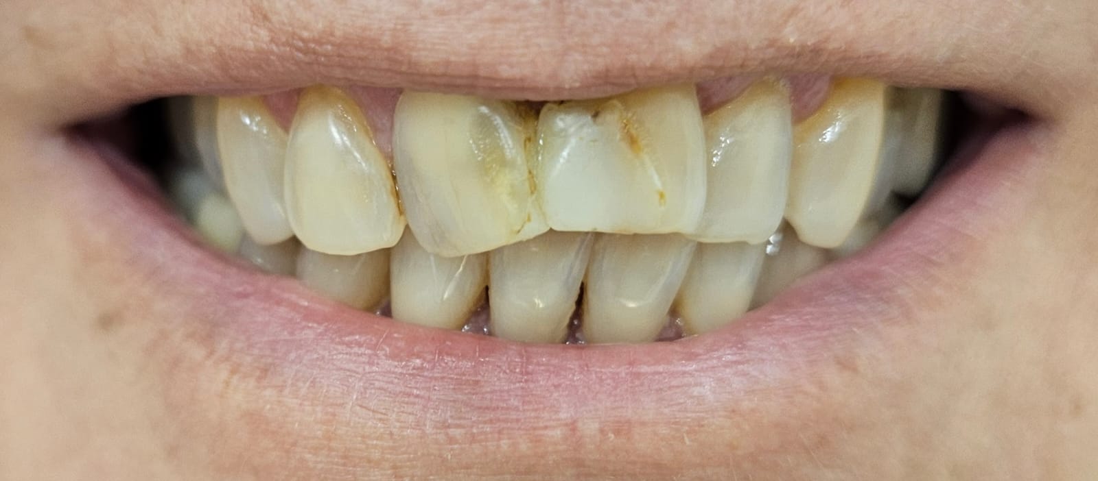 Caso clínico real BGA — antes del tratamiento de estética dental, registro del paciente