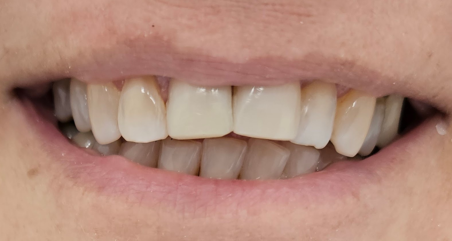 Caso clínico real BGA — después del tratamiento de estética dental, resultado armónico y natural