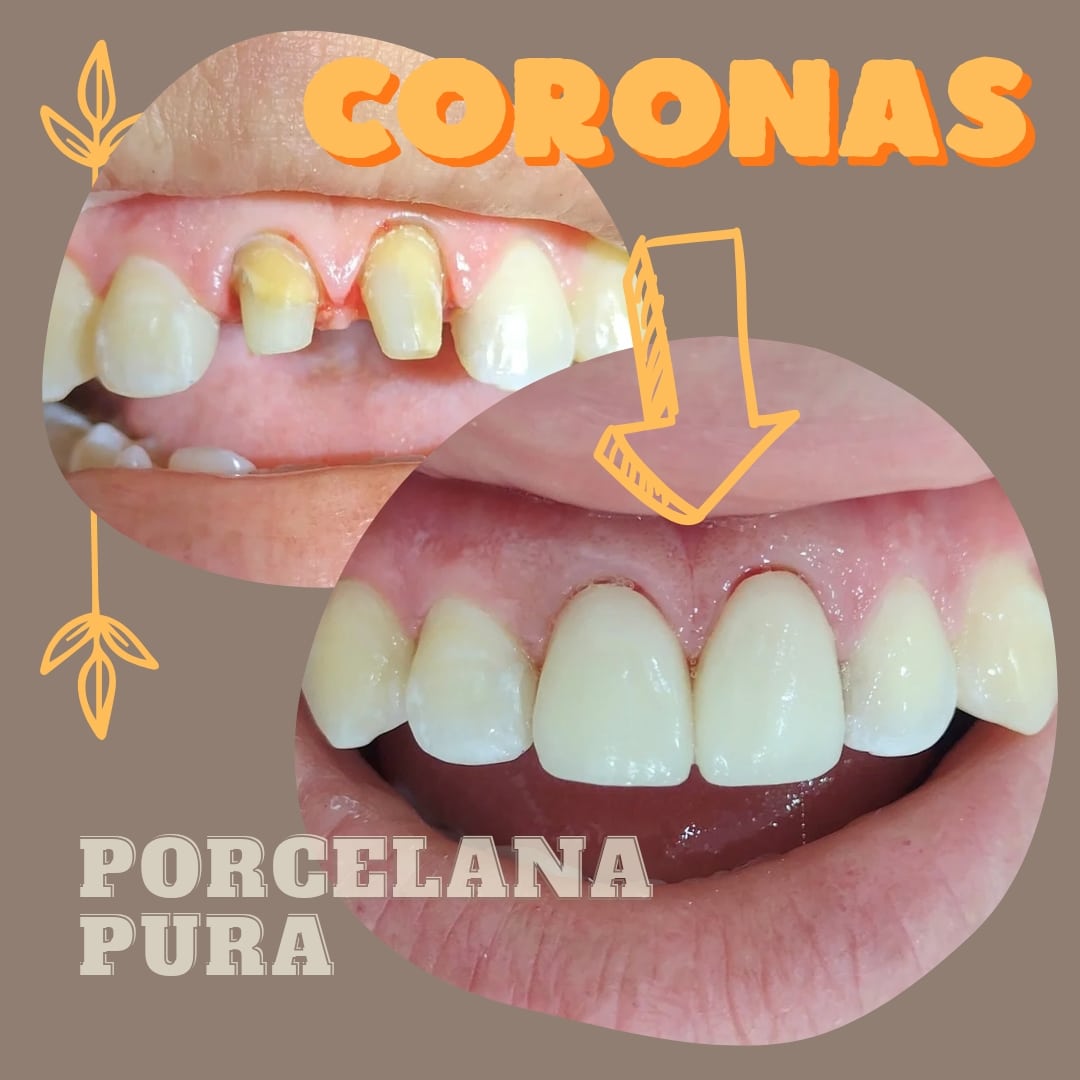 Caso clínico real BGA de coronas de porcelana — restauración estética del paciente
