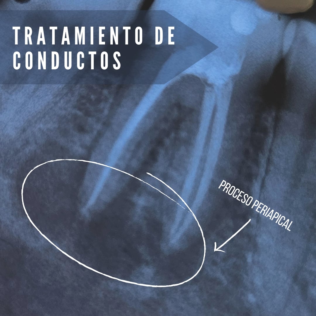 Radiografía de tratamiento de conductos BGA — endodoncia con sellado completo de canales