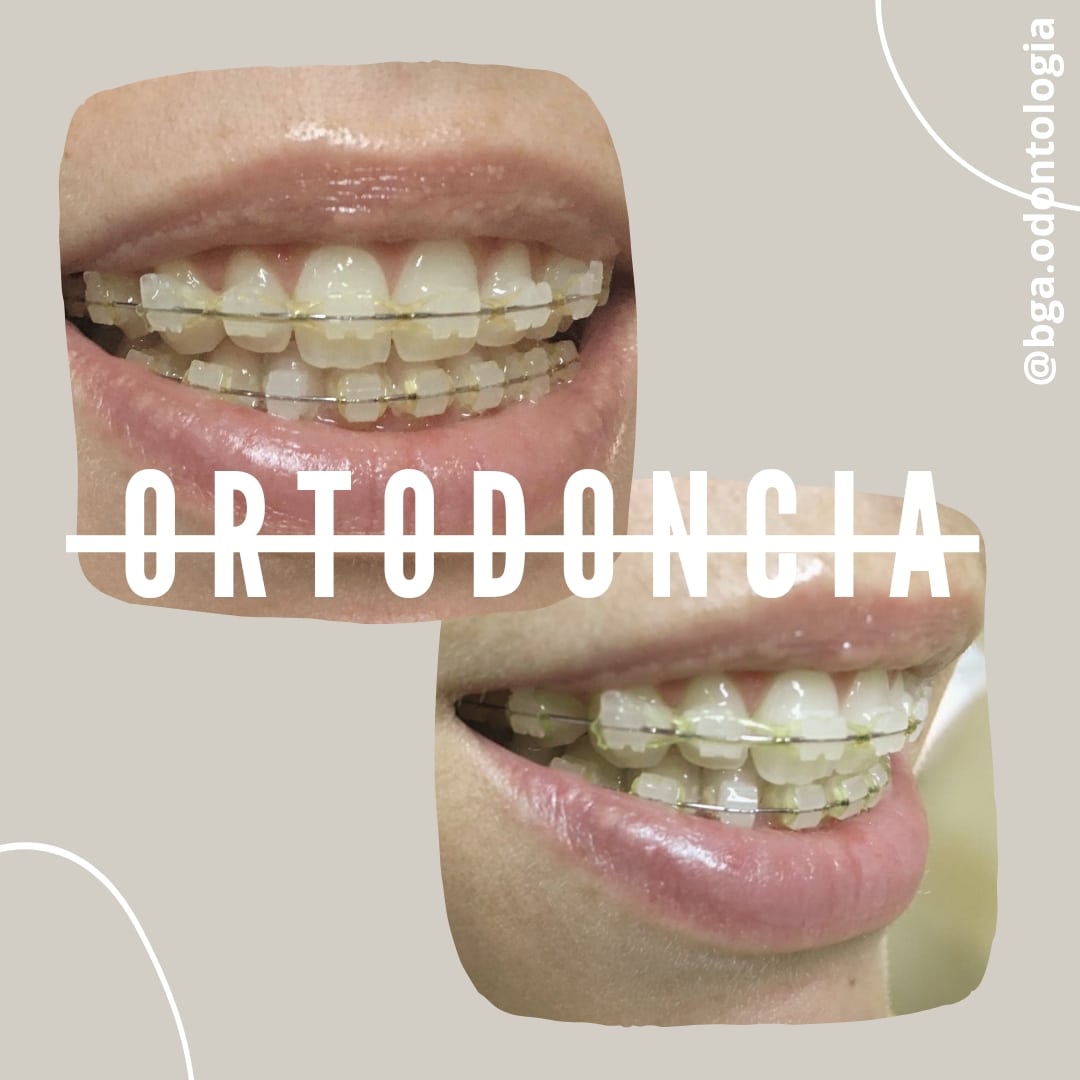 Caso clínico de ortodoncia BGA — alineación dental progresiva en paciente adulto