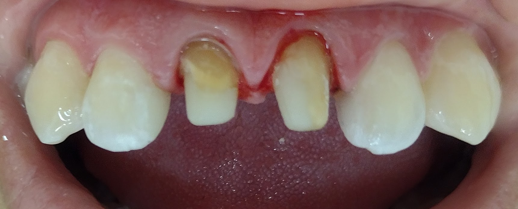 Caso clínico antes de coronas de porcelana — dientes desgastados con pérdida de estructura coronaria en BGA Palermo