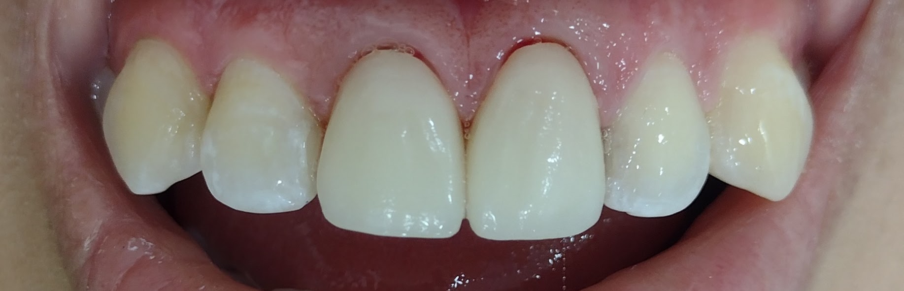 Resultado final con coronas de porcelana — restauración estética y funcional completada en BGA Palermo