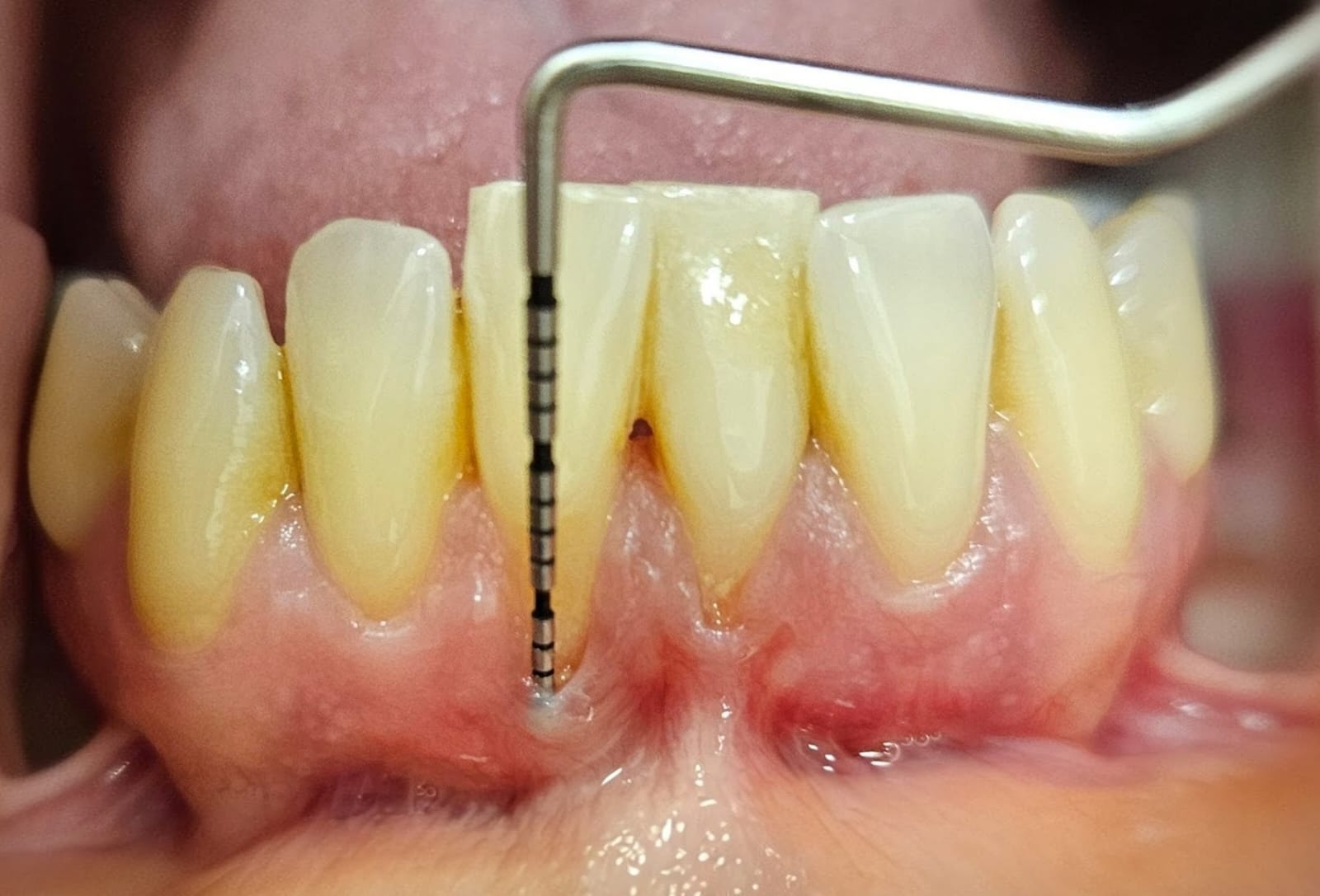 Tejido gingival — cirugía mucogingival y recesiones gingivales en BGA Palermo