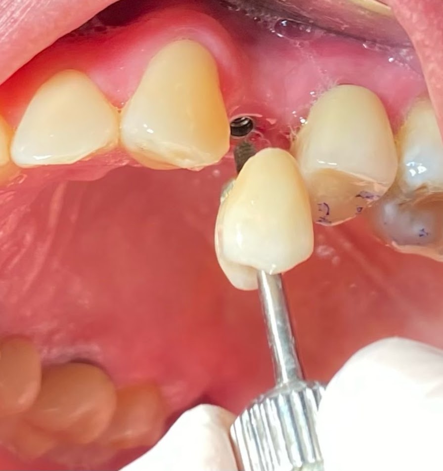 Implante dental en proceso BGA — vista intraoral, procedimiento real del consultorio