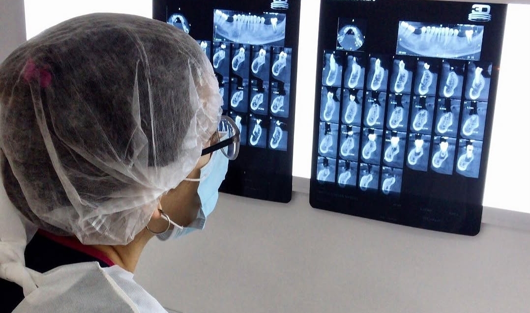Procedimiento de implante dental — colocación quirúrgica de precisión en BGA Palermo