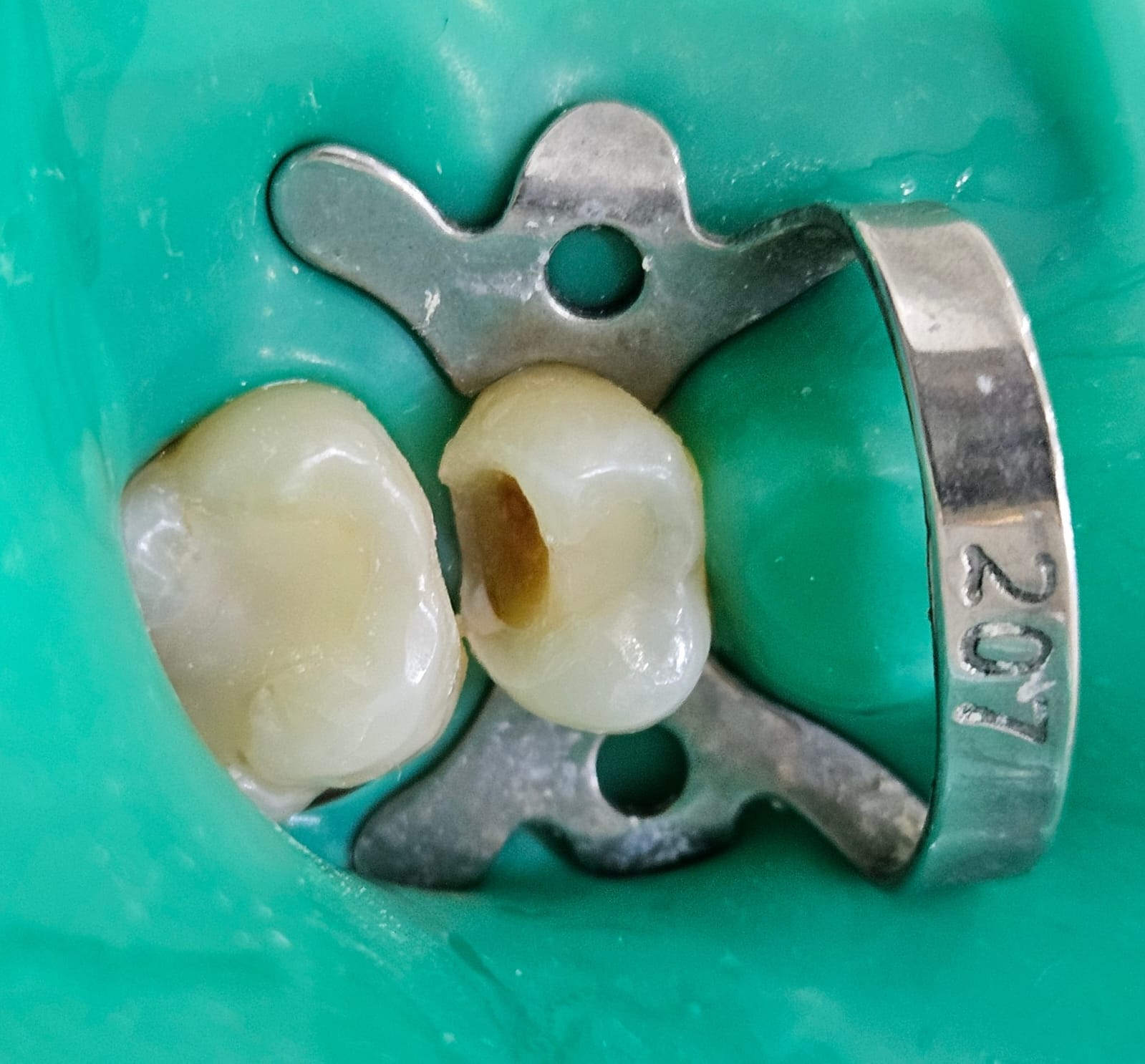 Caso clínico BGA — antes: pieza dental con cavidad previo a la restauración con resina compuesta