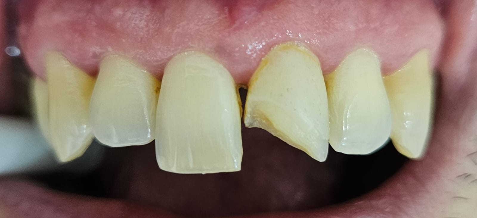 Caso clínico BGA — sonrisa con desgaste dental y asimetría previa al tratamiento de rehabilitación frontal