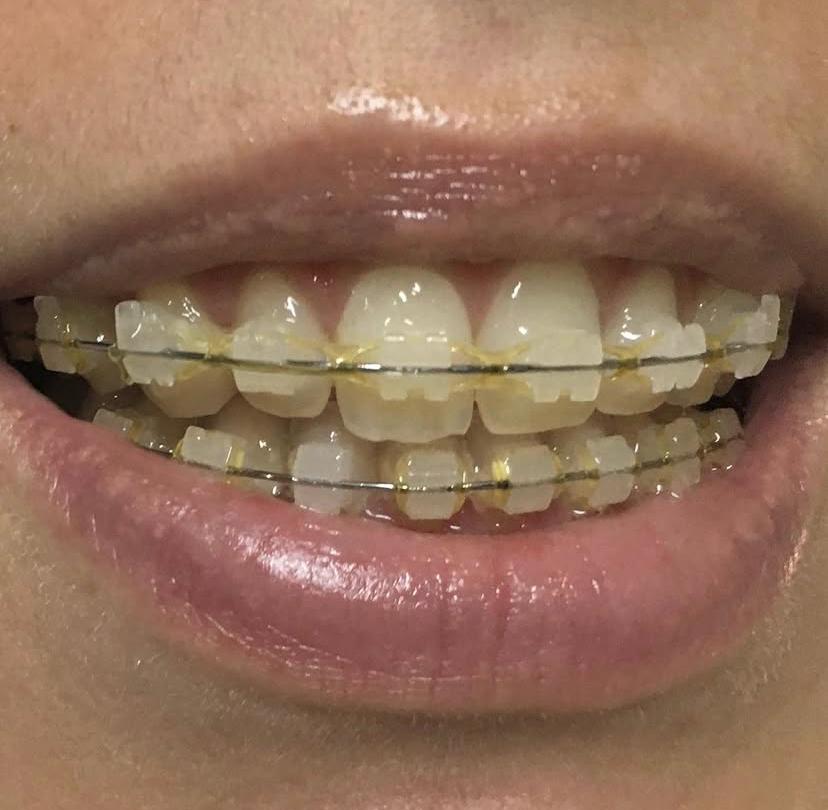 Bracket estético en tratamiento de ortodoncia adultos en BGA Palermo — alineación dentaria con criterio clínico
